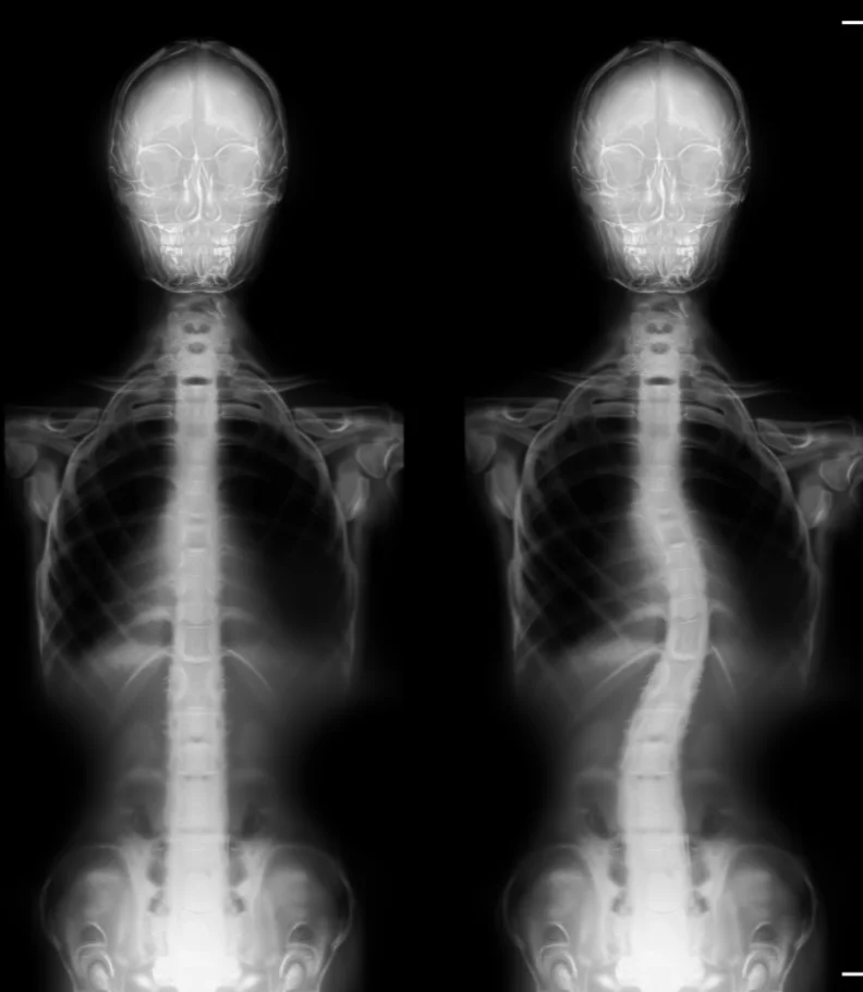 scoliosis Boone IA